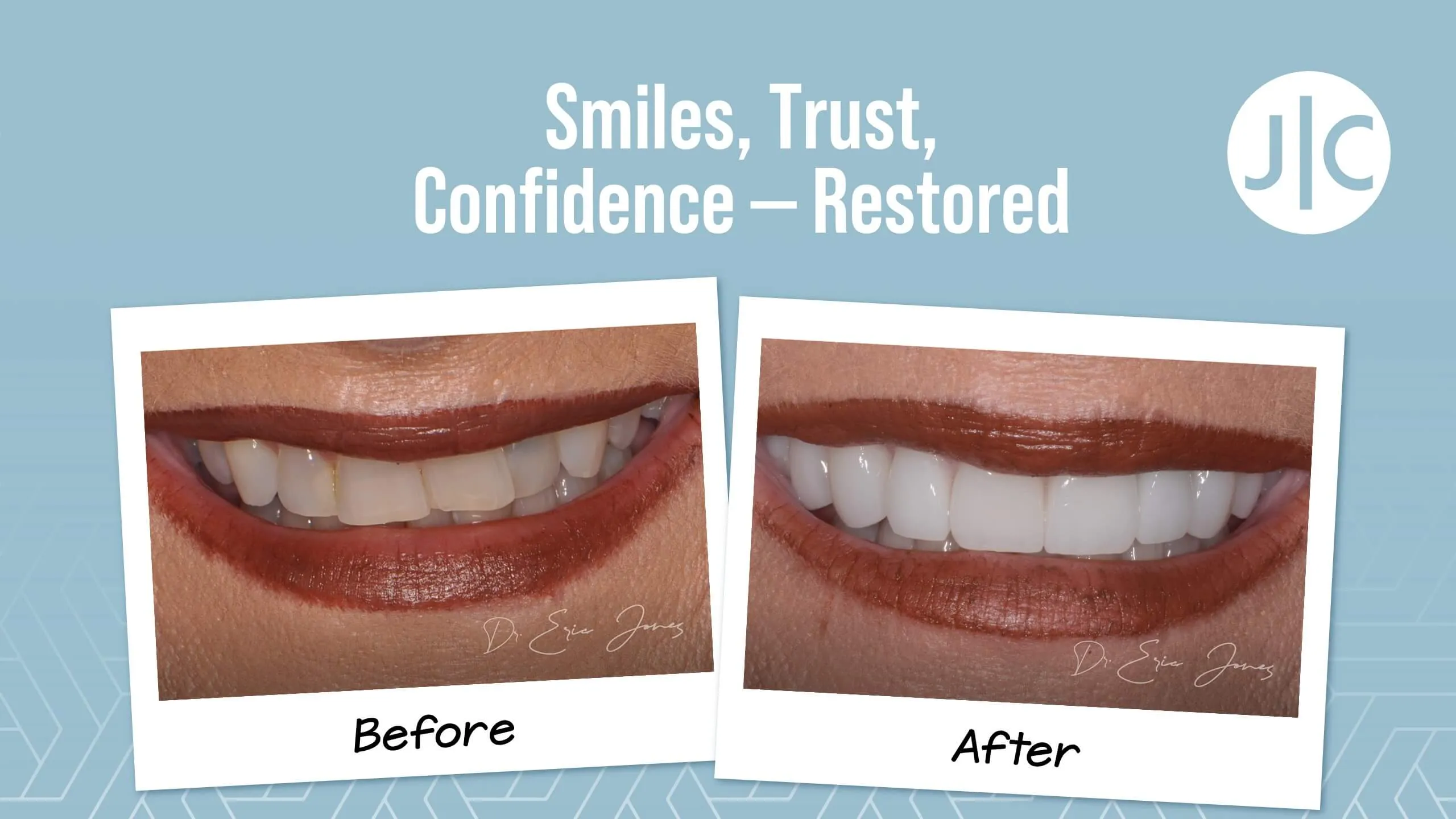 Full mouth reconstruction before and after